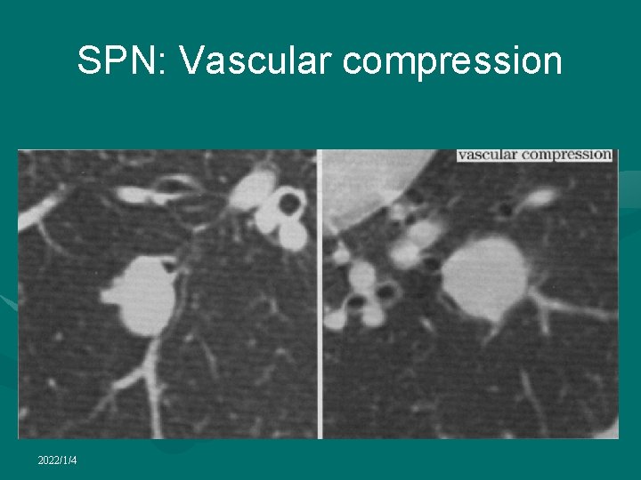 SPN: Vascular compression 2022/1/4 