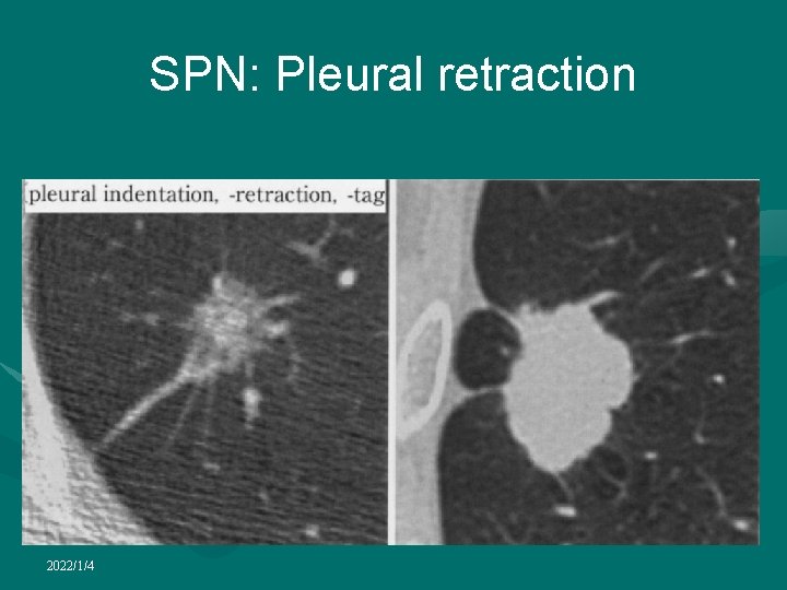 SPN: Pleural retraction 2022/1/4 