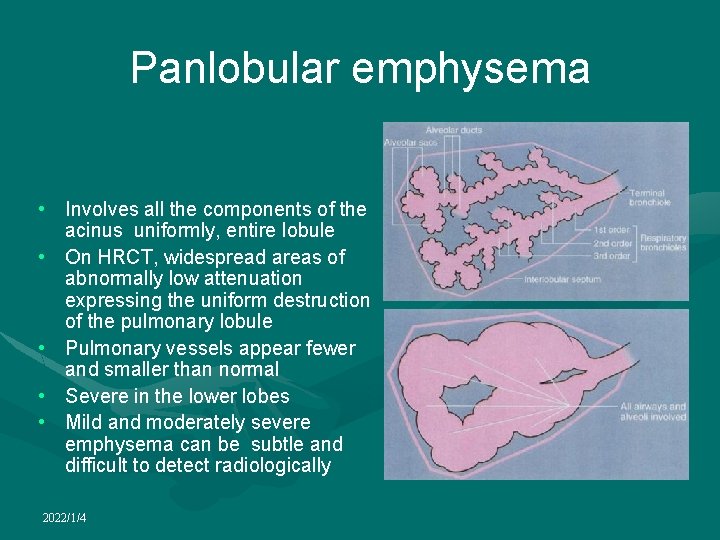 Panlobular emphysema • Involves all the components of the acinus uniformly, entire lobule •