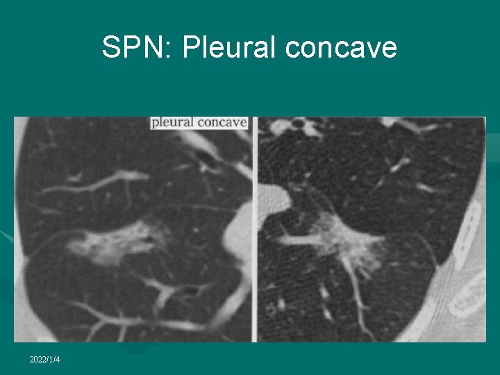 SPN: Pleural concave 2022/1/4 