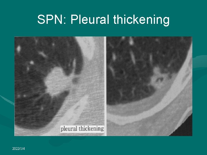 SPN: Pleural thickening 2022/1/4 