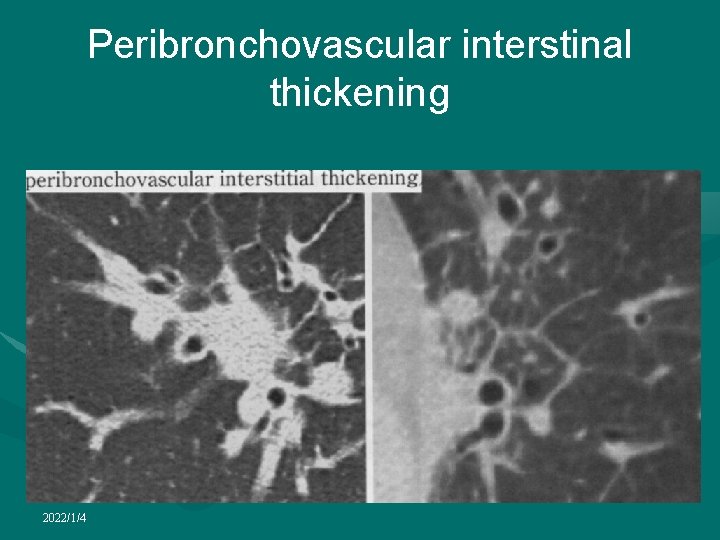 Peribronchovascular interstinal thickening 2022/1/4 