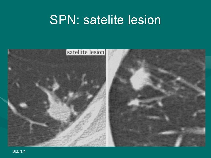 SPN: satelite lesion 2022/1/4 