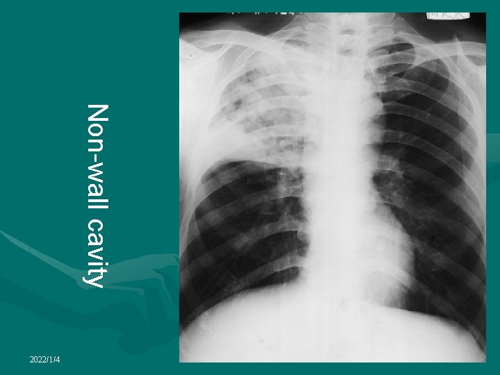 Non-wall cavity 2022/1/4 