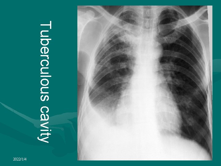 Tuberculous cavity 2022/1/4 