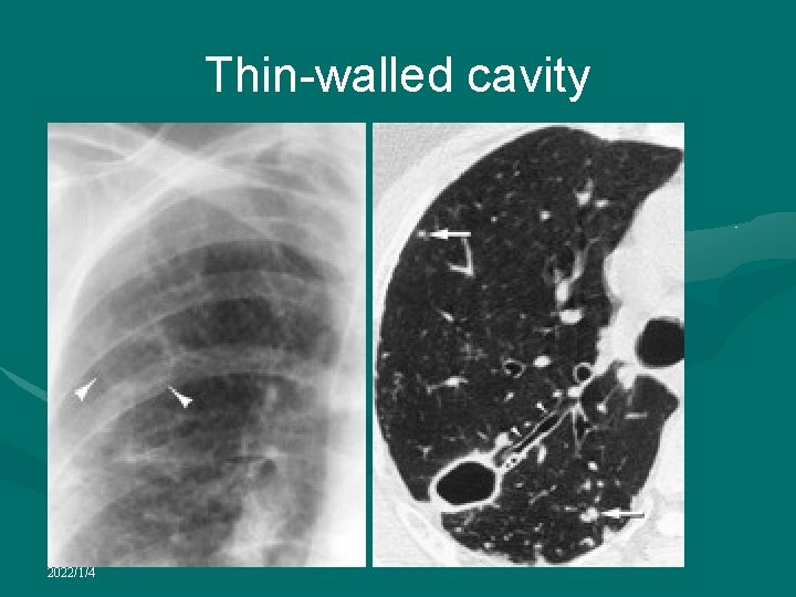 Thin-walled cavity 2022/1/4 