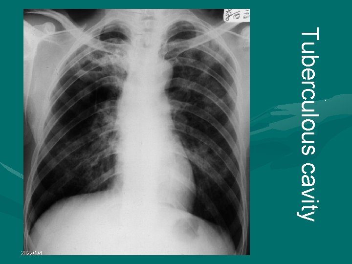 Tuberculous cavity 2022/1/4 