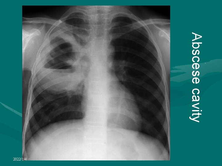 Abscese cavity 2022/1/4 