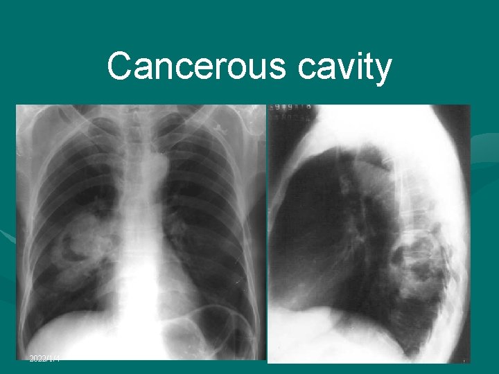 Cancerous cavity 2022/1/4 