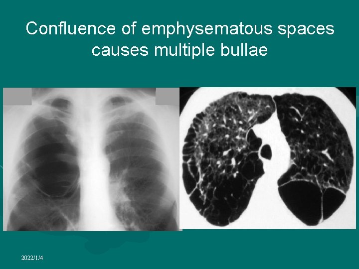 Confluence of emphysematous spaces causes multiple bullae 2022/1/4 