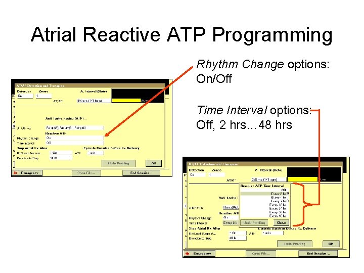 Atrial Reactive ATP Programming Rhythm Change options: On/Off Time Interval options: Off, 2 hrs…