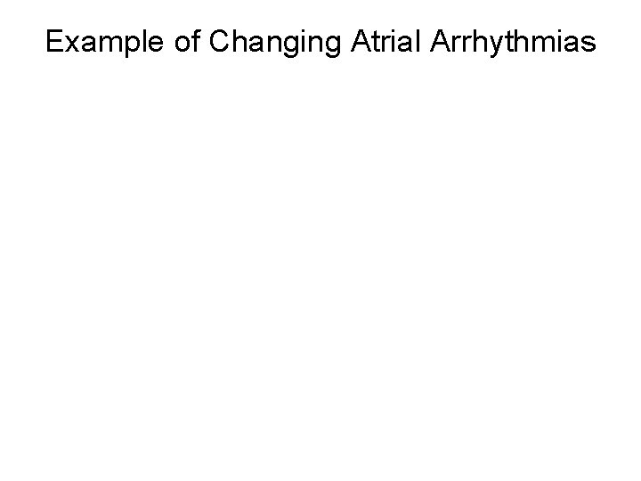 Example of Changing Atrial Arrhythmias 