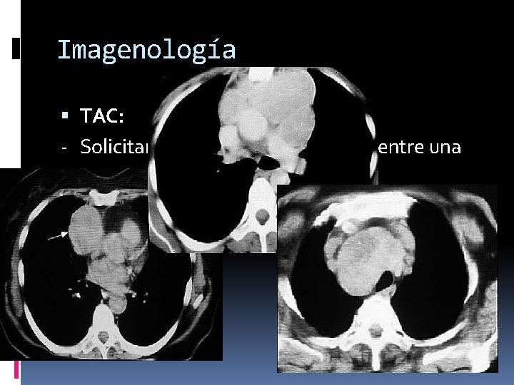 Imagenología TAC: - Solicitar TAC siempre que se encuentre una masa mediastínica en la