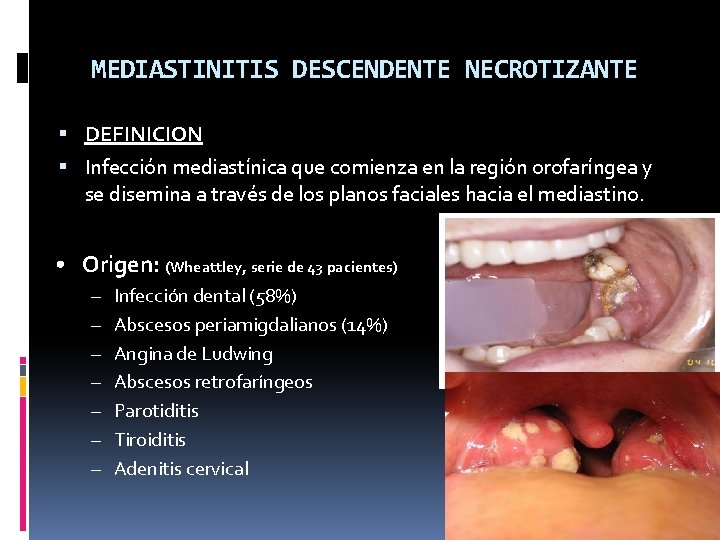 MEDIASTINITIS DESCENDENTE NECROTIZANTE DEFINICION Infección mediastínica que comienza en la región orofaríngea y se