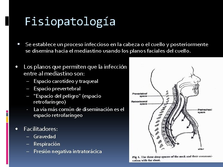 Fisiopatología Se establece un proceso infeccioso en la cabeza o el cuello y posteriormente