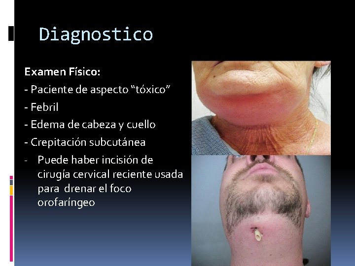 Diagnostico Examen Físico: - Paciente de aspecto “tóxico” - Febril - Edema de cabeza