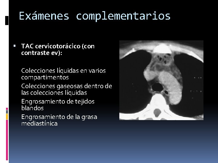 Exámenes complementarios TAC cervicotorácico (con contraste ev): Colecciones líquidas en varios compartimentos Colecciones gaseosas