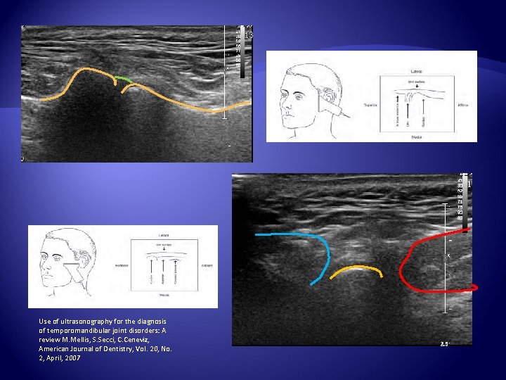 Use of ultrasonography for the diagnosis of temporomandibular joint disorders: A review M. Mellis,