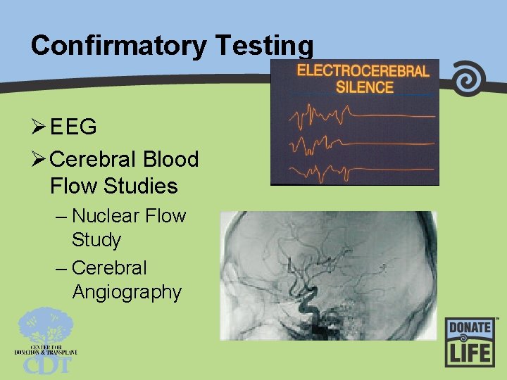 Confirmatory Testing Ø EEG Ø Cerebral Blood Flow Studies – Nuclear Flow Study –