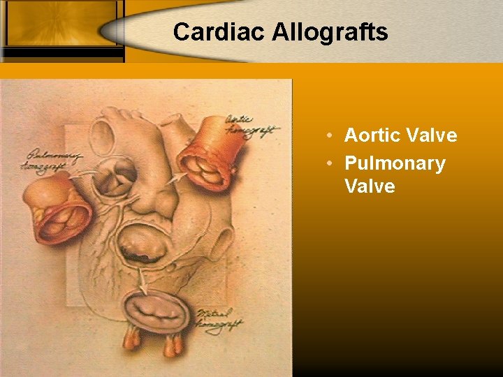 Cardiac Allografts • Aortic Valve • Pulmonary Valve 