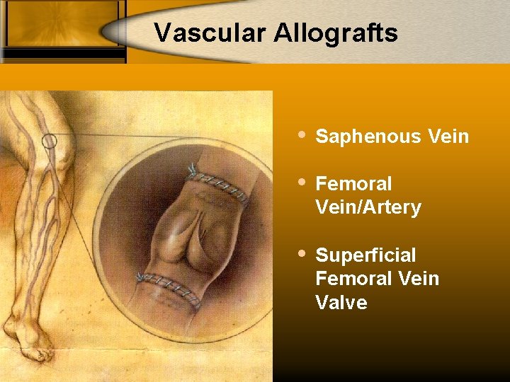 Vascular Allografts Saphenous Vein Femoral Vein/Artery Superficial Femoral Vein Valve 