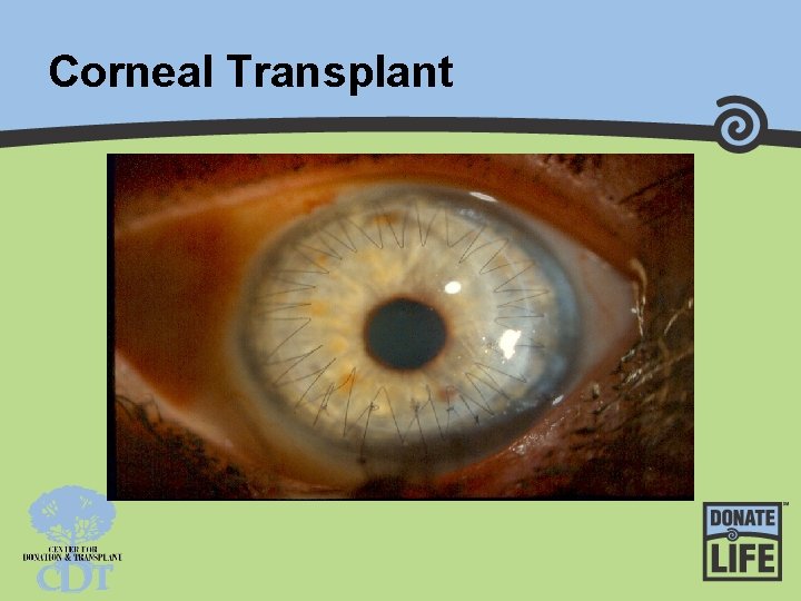 Corneal Transplant 