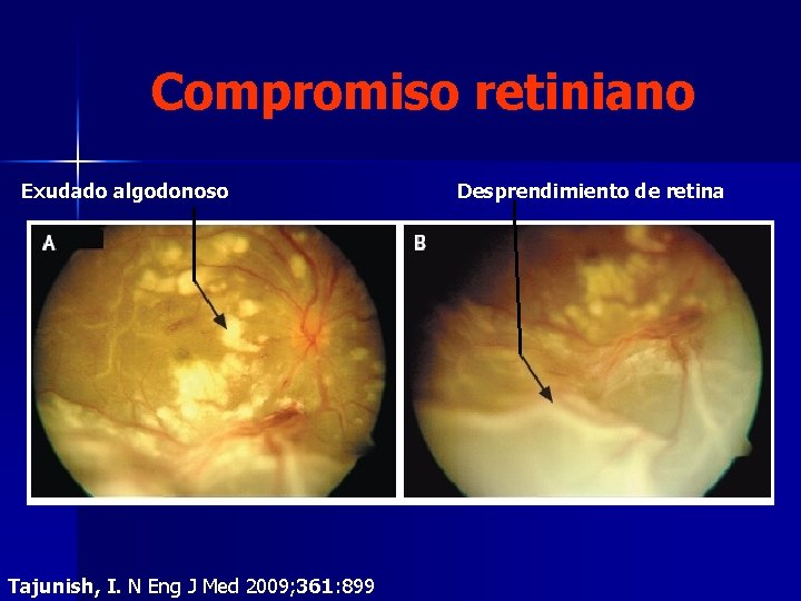 Compromiso retiniano Exudado algodonoso Tajunish, I. N Eng J Med 2009; 361: 899 Desprendimiento Compromiso retiniano Exudado algodonoso Tajunish, I. N Eng J Med 2009; 361: 899 Desprendimiento