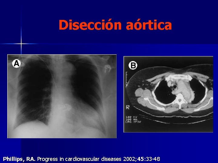 Disección aórtica Phillips, RA. Progress in cardiovascular diseases 2002; 45: 33 -48 Disección aórtica Phillips, RA. Progress in cardiovascular diseases 2002; 45: 33 -48
