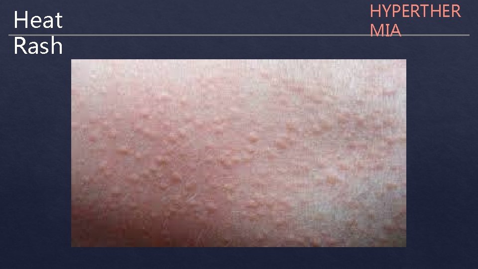 Heat Rash HYPERTHER MIA 