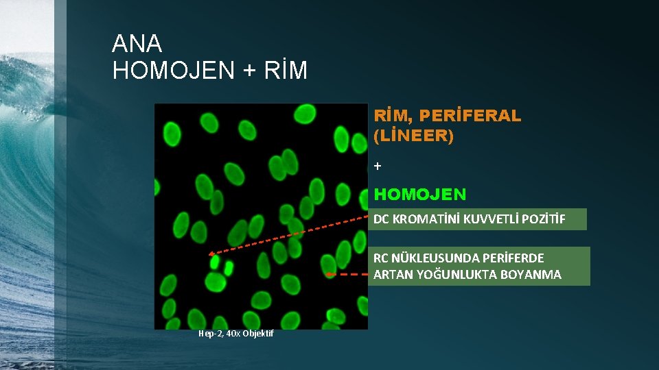 ANA HOMOJEN + RİM, PERİFERAL (LİNEER) + HOMOJEN DC KROMATİNİ KUVVETLİ POZİTİF RC NÜKLEUSUNDA