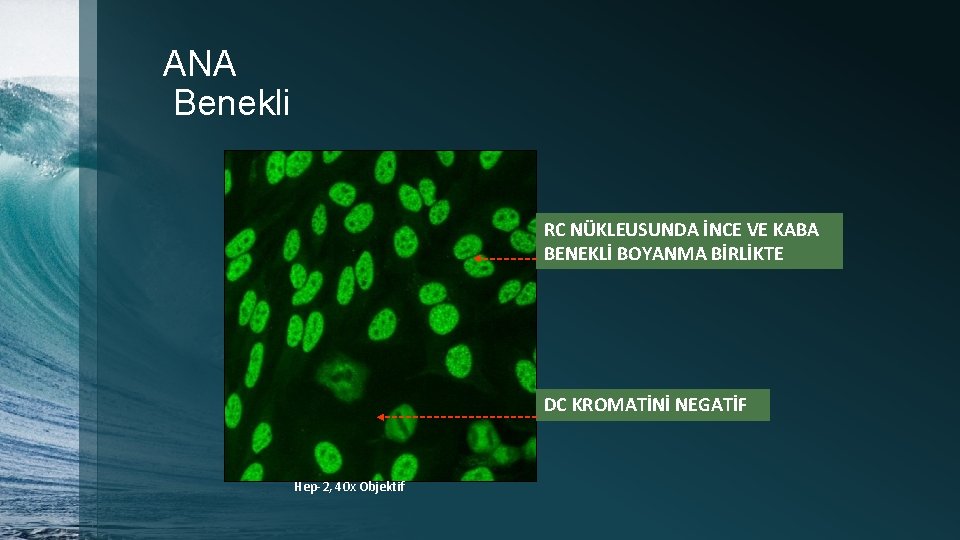 ANA Benekli RC NÜKLEUSUNDA İNCE VE KABA BENEKLİ BOYANMA BİRLİKTE DC KROMATİNİ NEGATİF Hep-2,