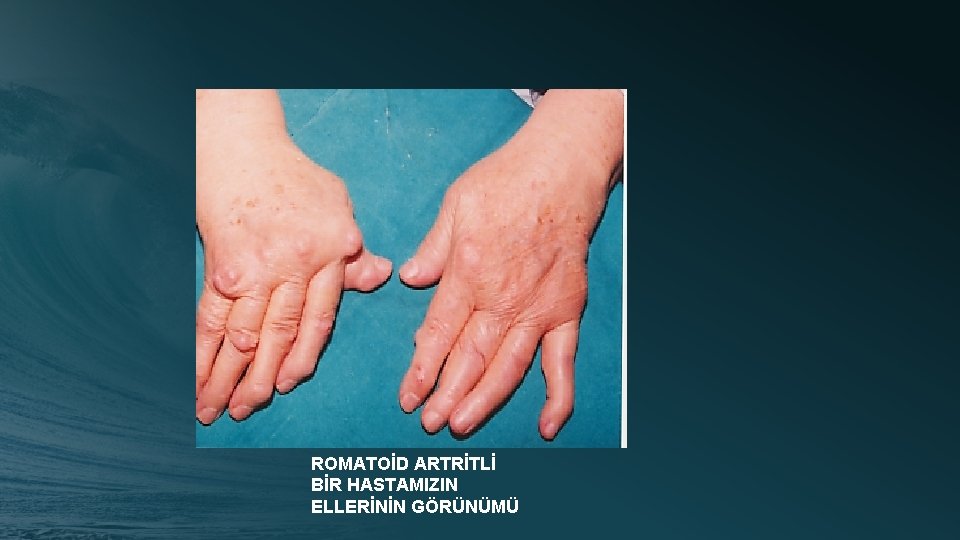 ROMATOİD ARTRİTLİ BİR HASTAMIZIN ELLERİNİN GÖRÜNÜMÜ 