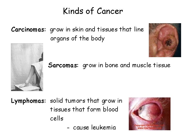 Kinds of Cancer Carcinomas: grow in skin and tissues that line organs of the
