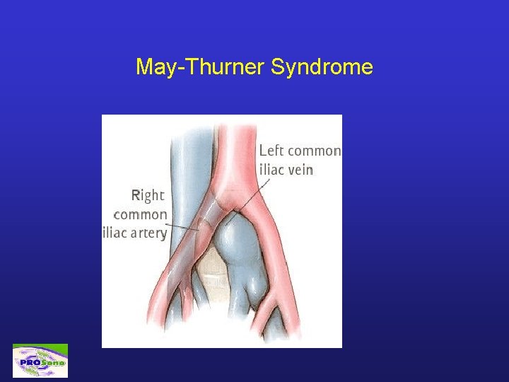 May-Thurner Syndrome 