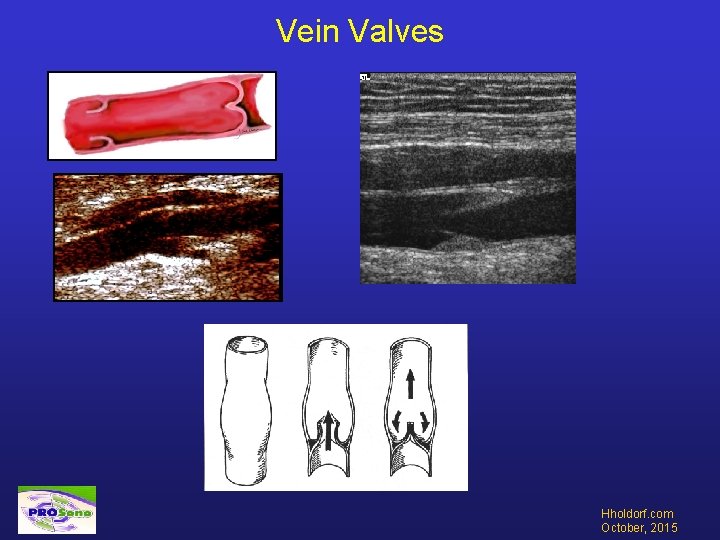 Vein Valves Hholdorf. com October, 2015 