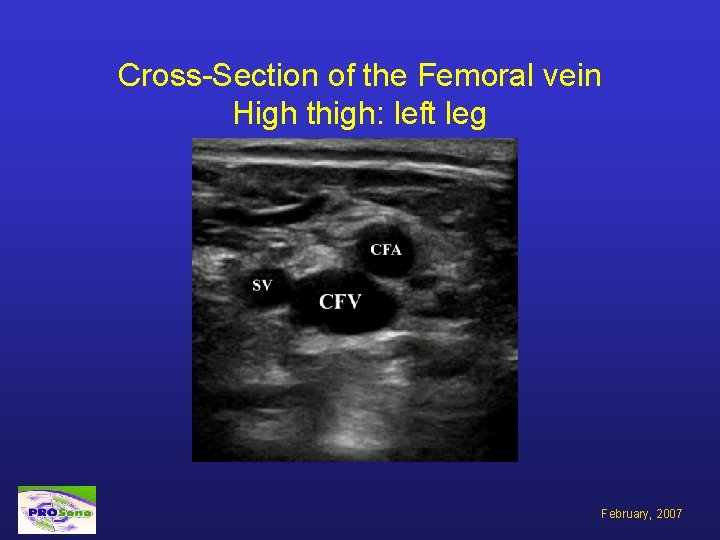 Cross-Section of the Femoral vein High thigh: left leg February, 2007 