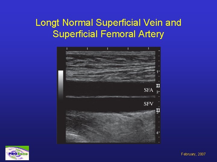 Longt Normal Superficial Vein and Superficial Femoral Artery February, 2007 