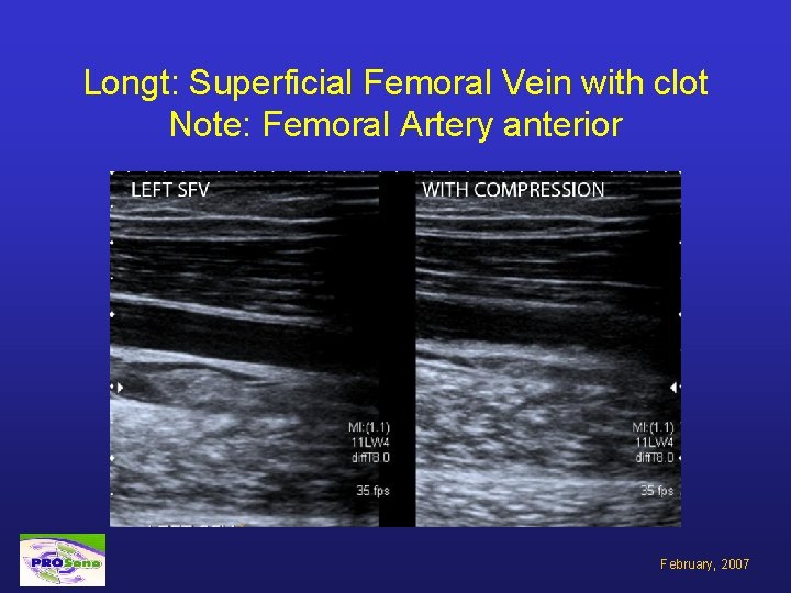 Longt: Superficial Femoral Vein with clot Note: Femoral Artery anterior February, 2007 
