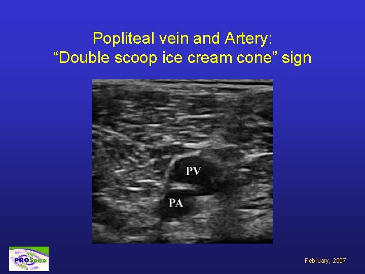 Popliteal vein and Artery: “Double scoop ice cream cone” sign February, 2007 