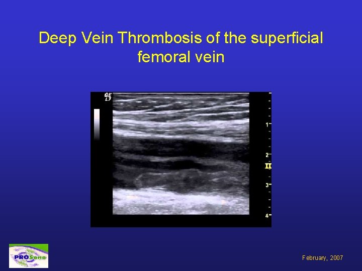 Deep Vein Thrombosis of the superficial femoral vein February, 2007 