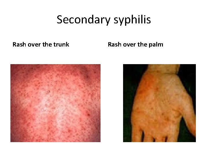 Secondary syphilis Rash over the trunk Rash over the palm 