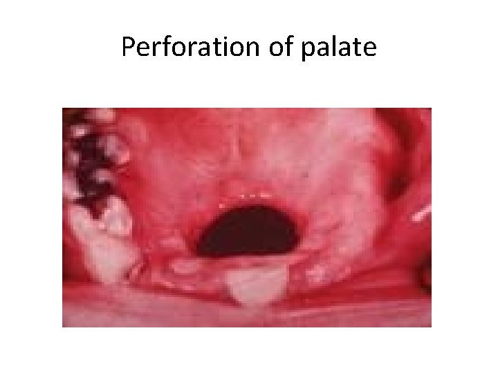 Perforation of palate 