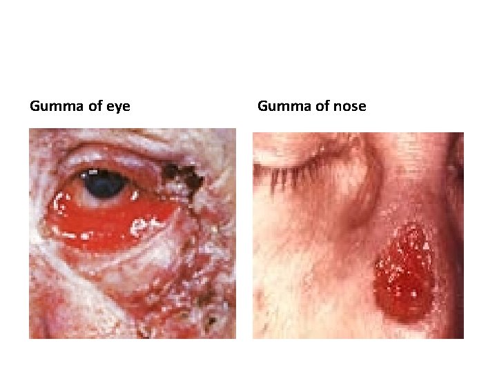 Gumma of eye Gumma of nose 