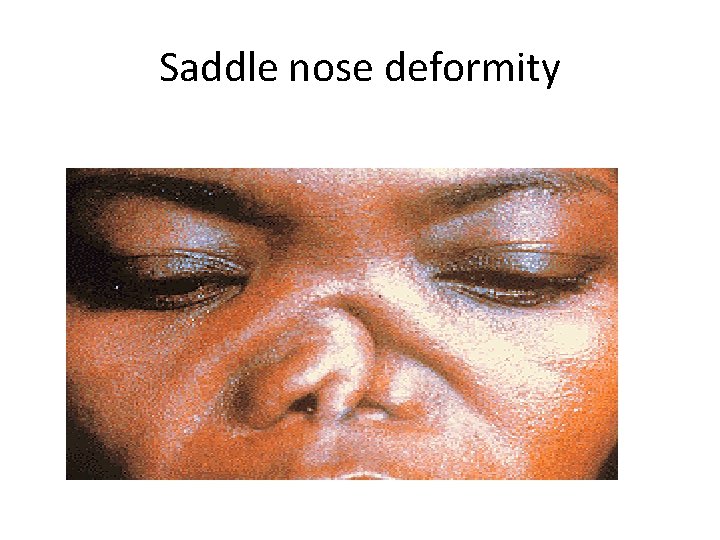 Saddle nose deformity 
