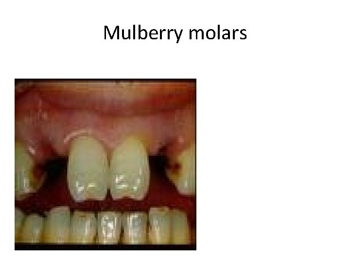 Mulberry molars 