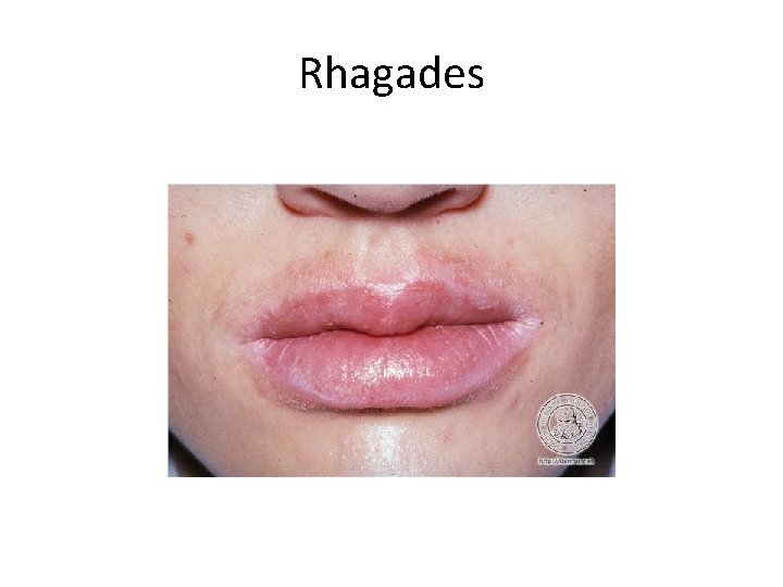 Rhagades 