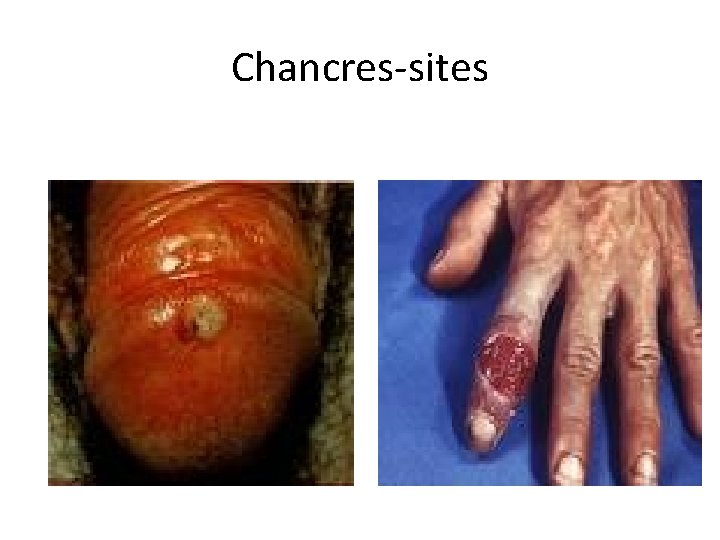 Chancres-sites 