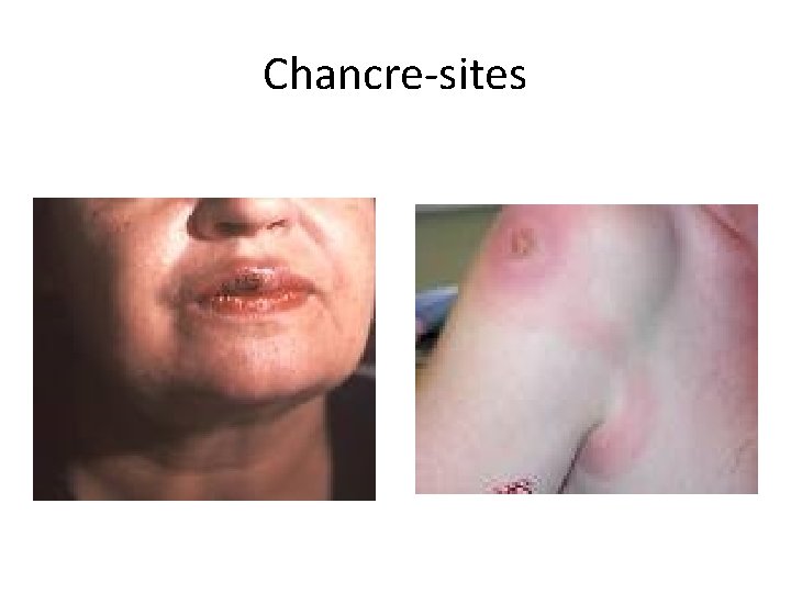Chancre-sites 