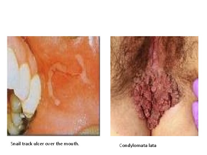 Snail track ulcer over the mouth. Condylomata lata 