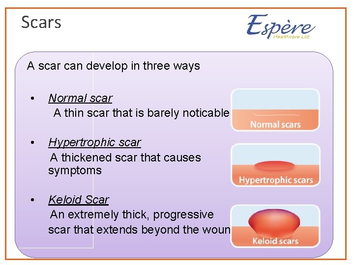 Scars A scar can develop in three ways • Normal scar A thin scar